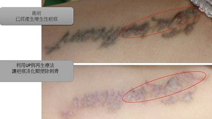 蟹足腫