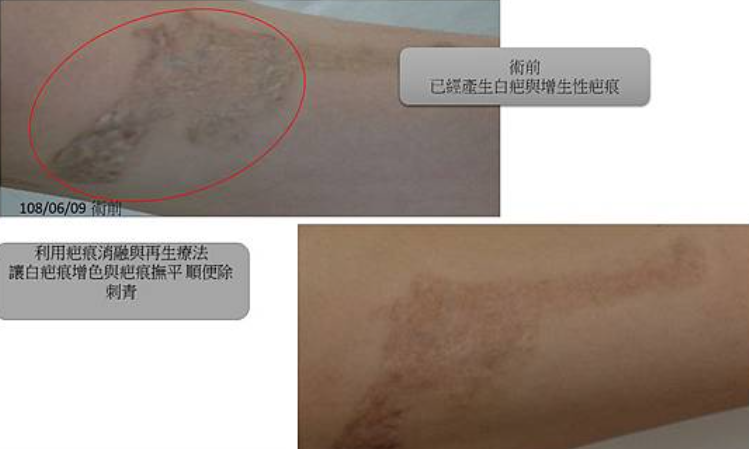 蟹足腫