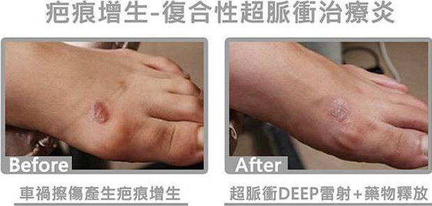 蟹足腫