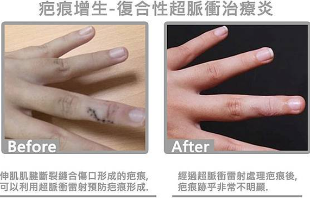 蟹足腫