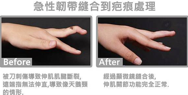 蟹足腫
