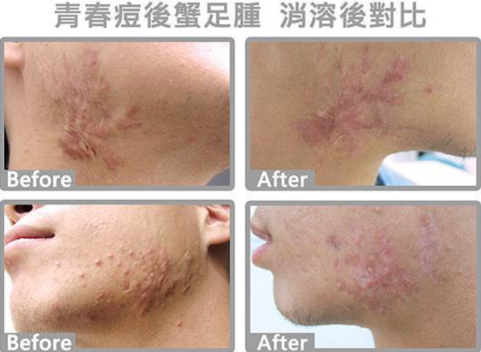 蟹足腫