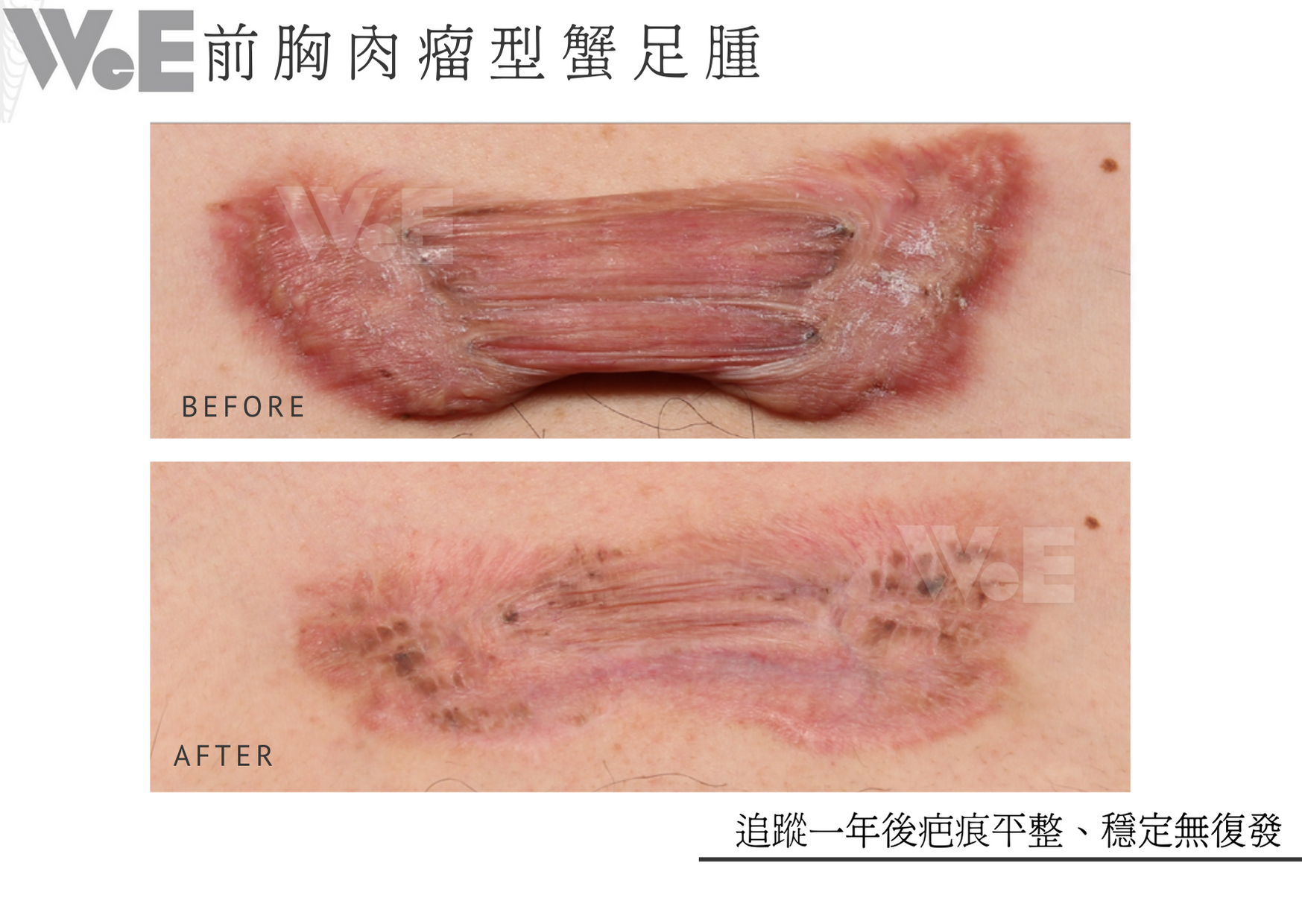 蟹足腫