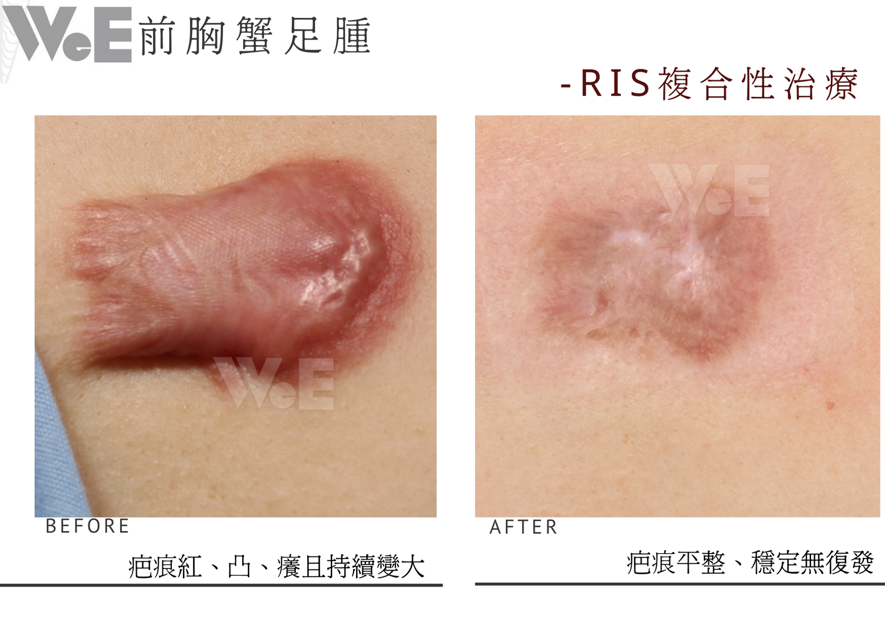 蟹足腫