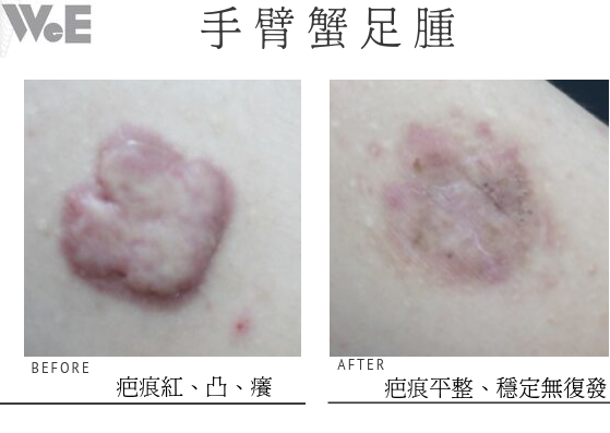蟹足腫