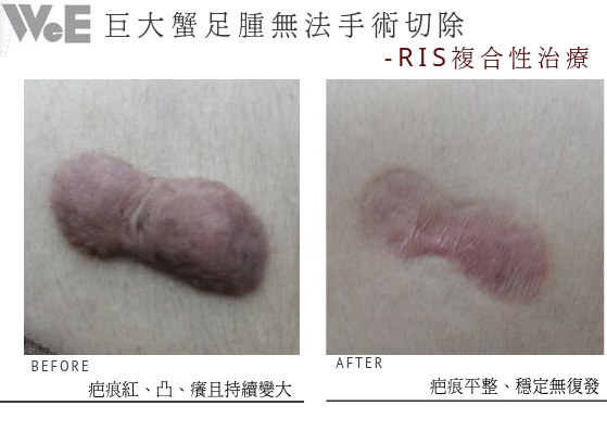 蟹足腫