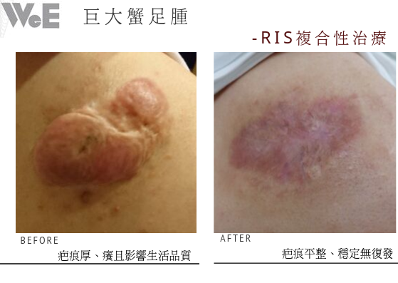蟹足腫