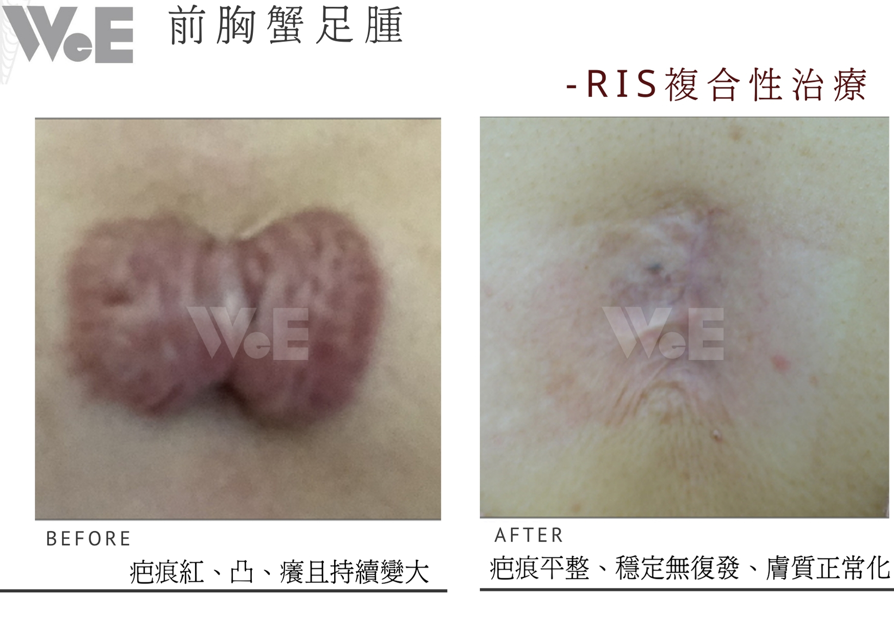 蟹足腫