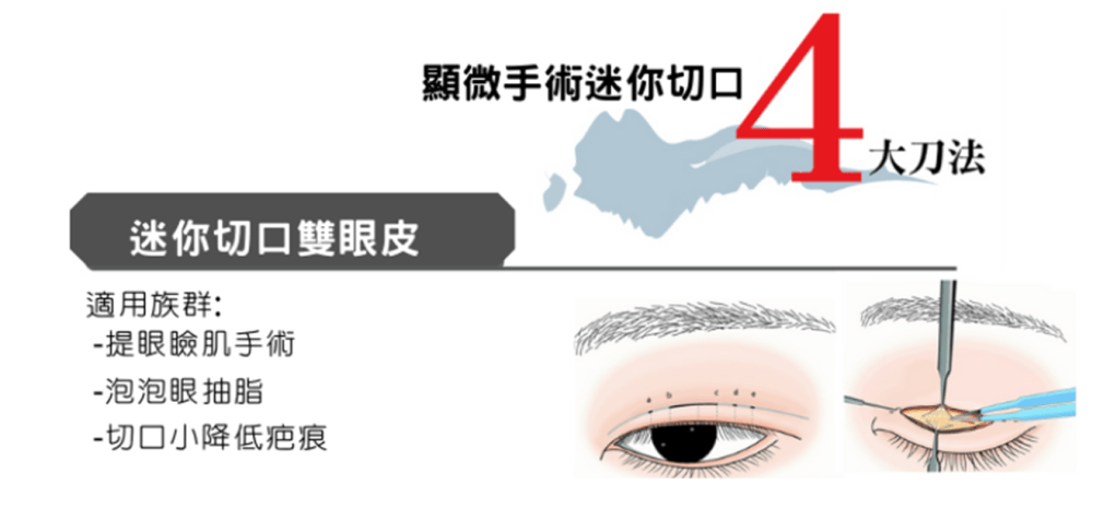 迷你切口雙眼皮