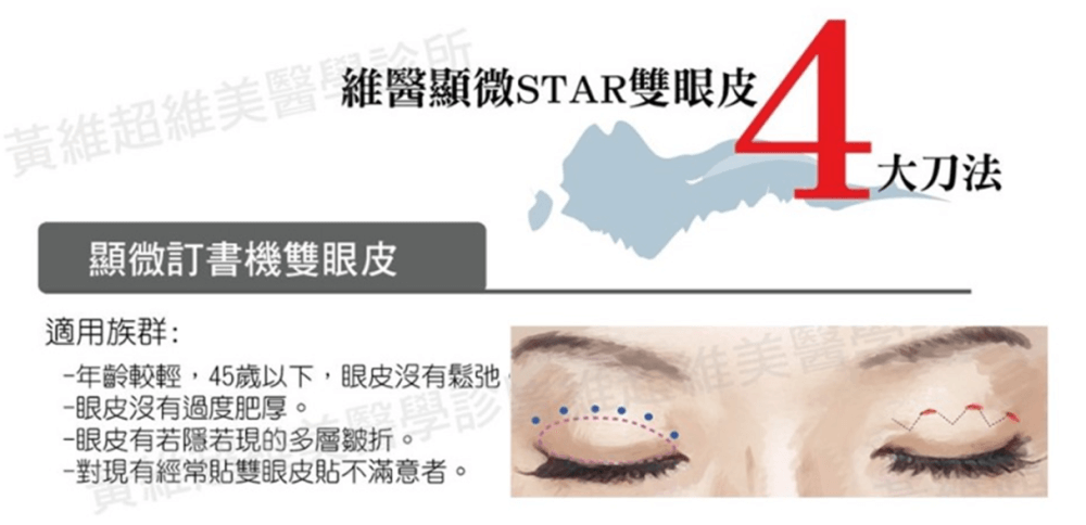 訂書針雙眼皮