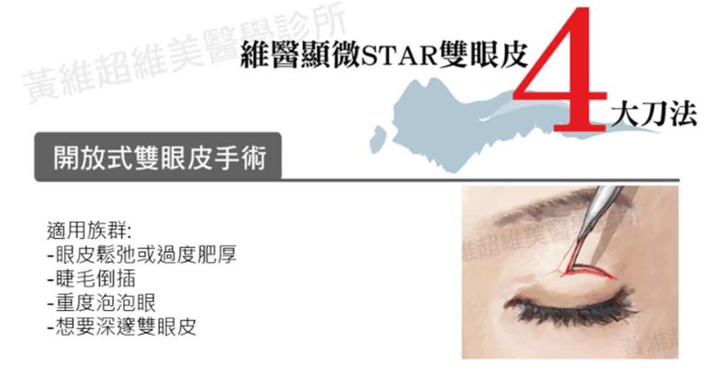 開放式雙眼皮