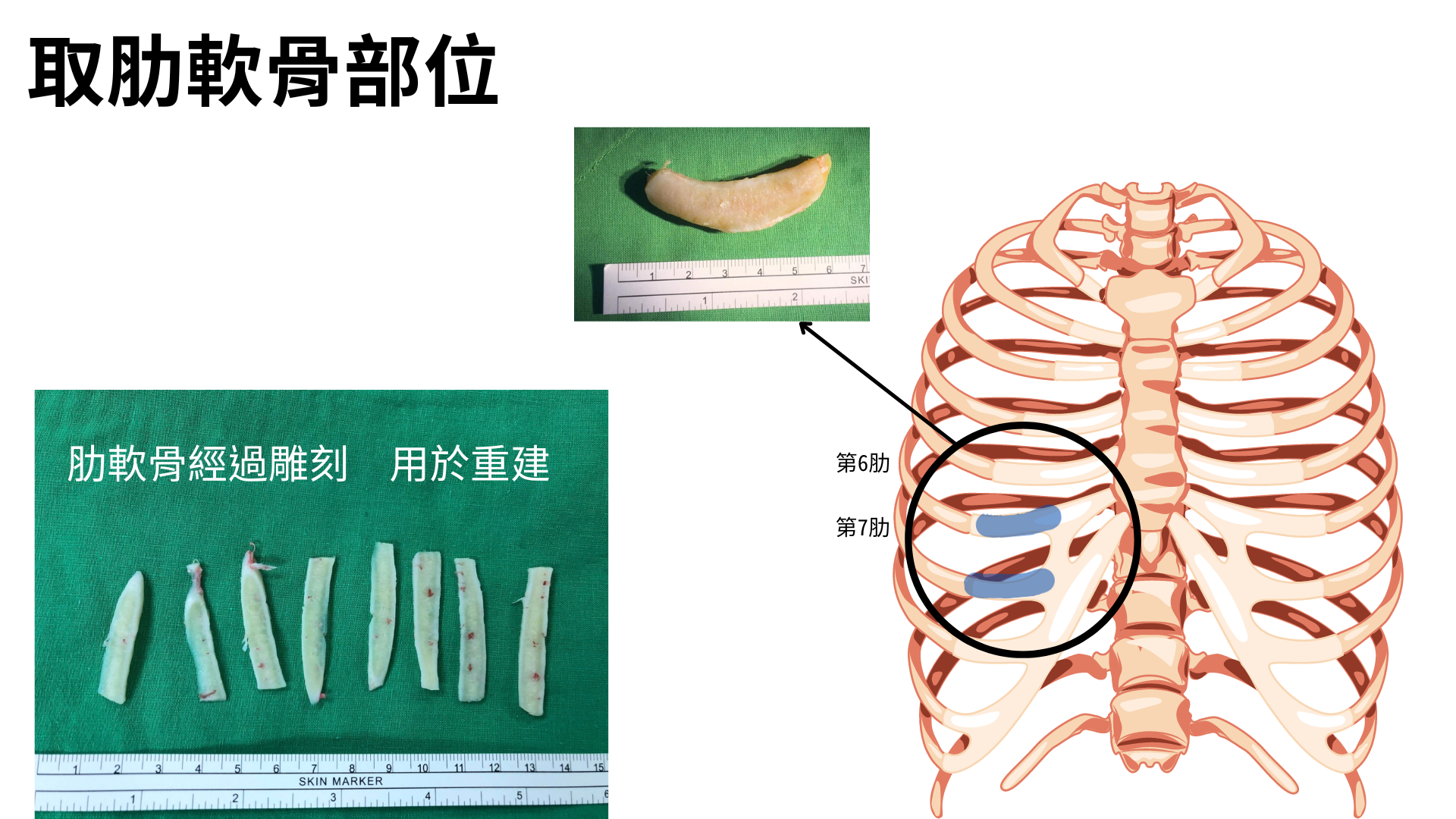 取軟骨位置