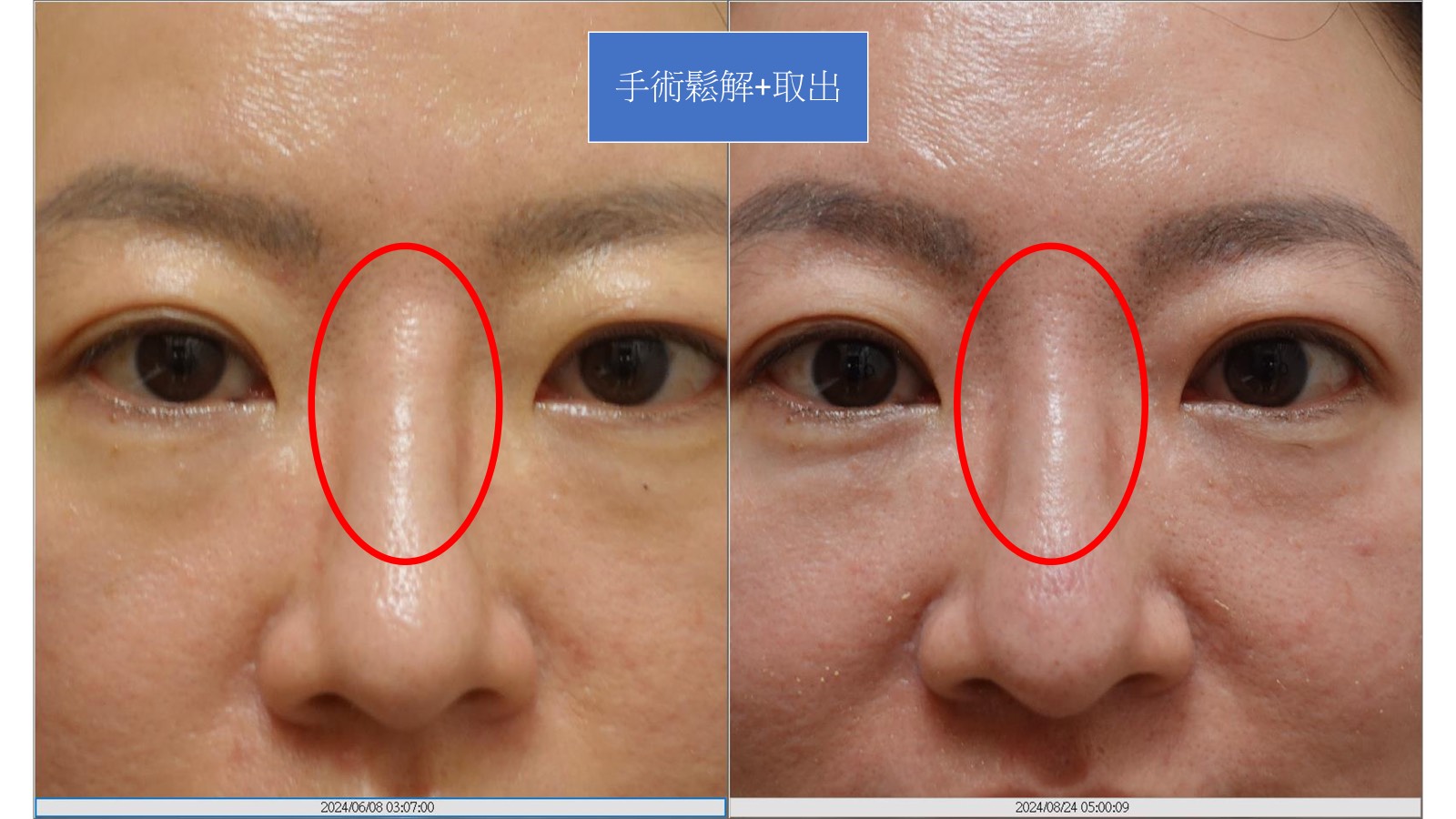 鼻部組織減容術後成效圖