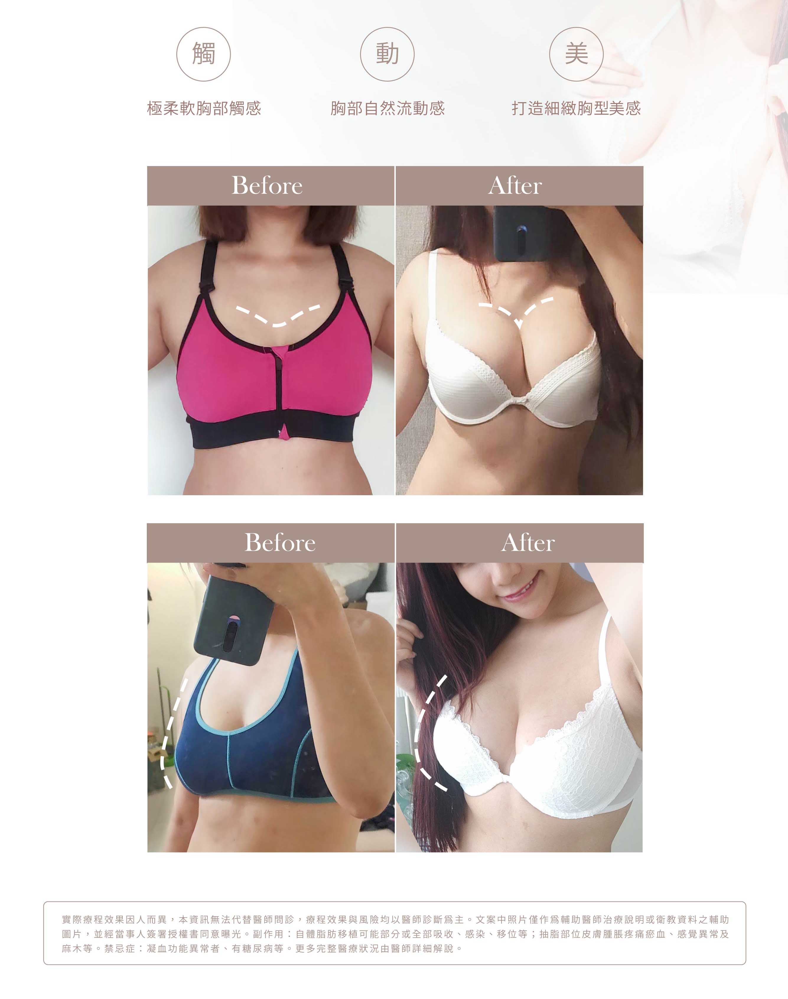 台中抽脂補胸