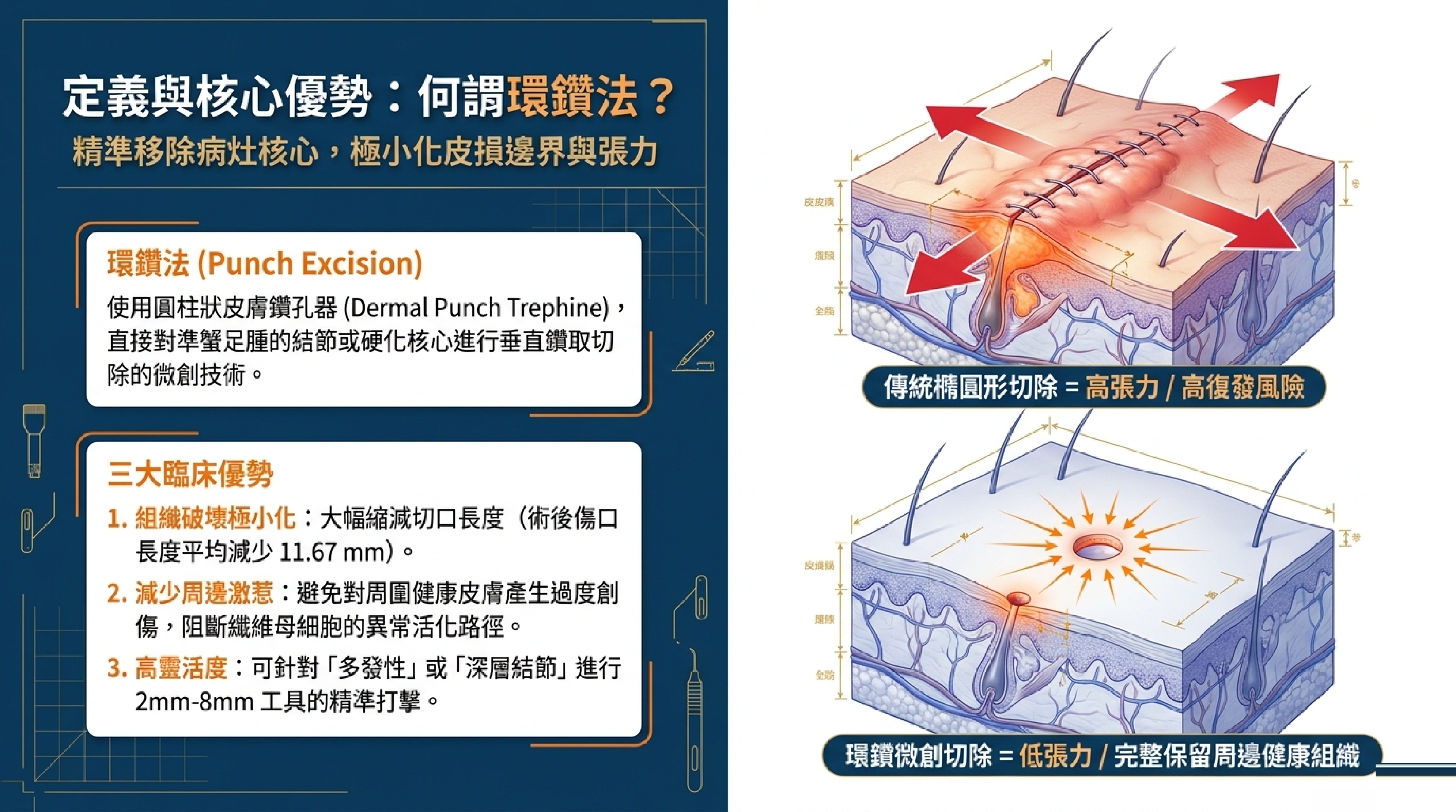 環鑽法 Punch Excision 定義：使用圓柱狀皮膚鑽孔器精準去核，極小化皮損邊界與張力