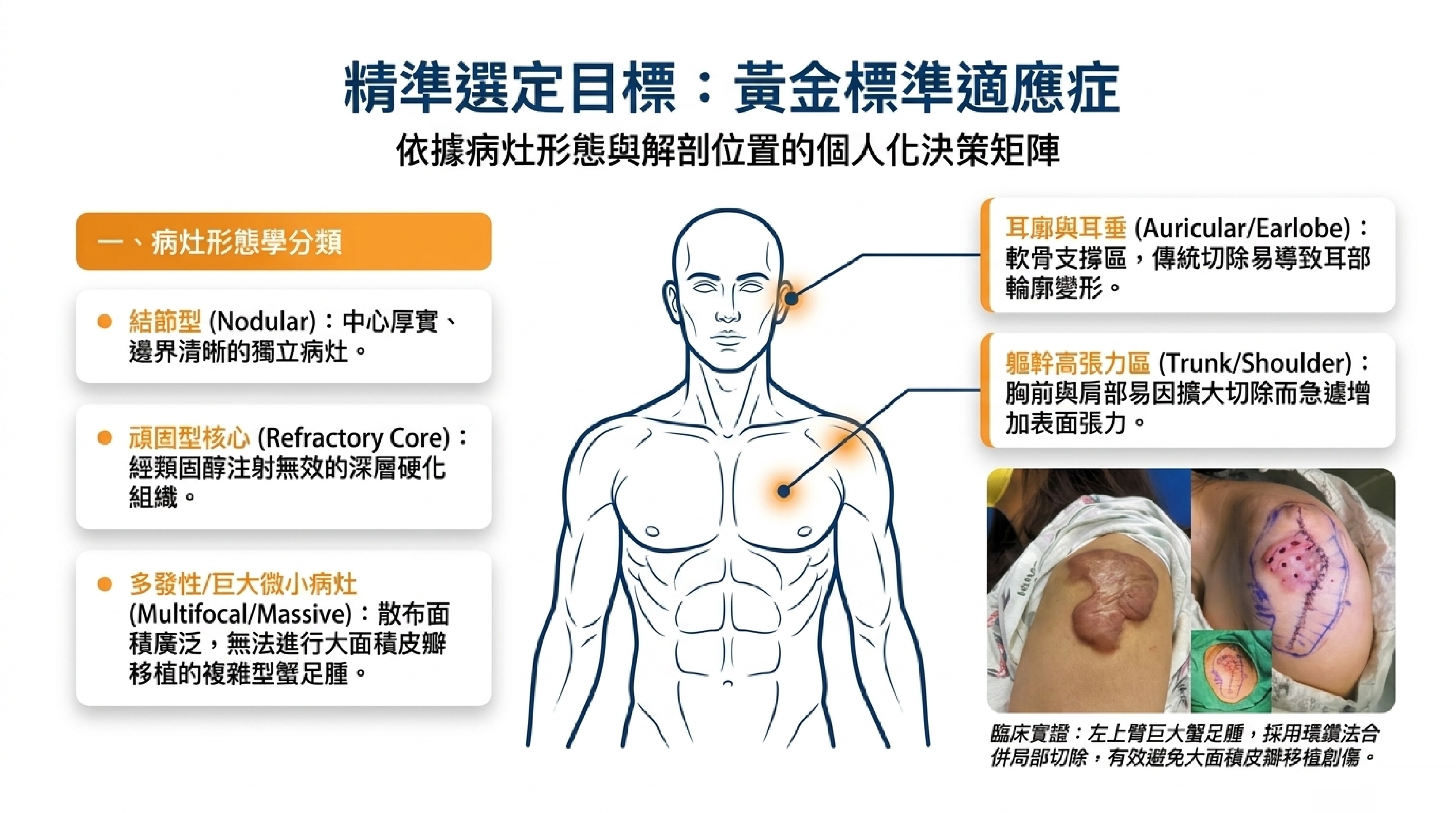 蟹足腫黃金標準適應症：結節型、頑固型核心、多發性、耳廓與軀幹高張力區的病灶形態學分類