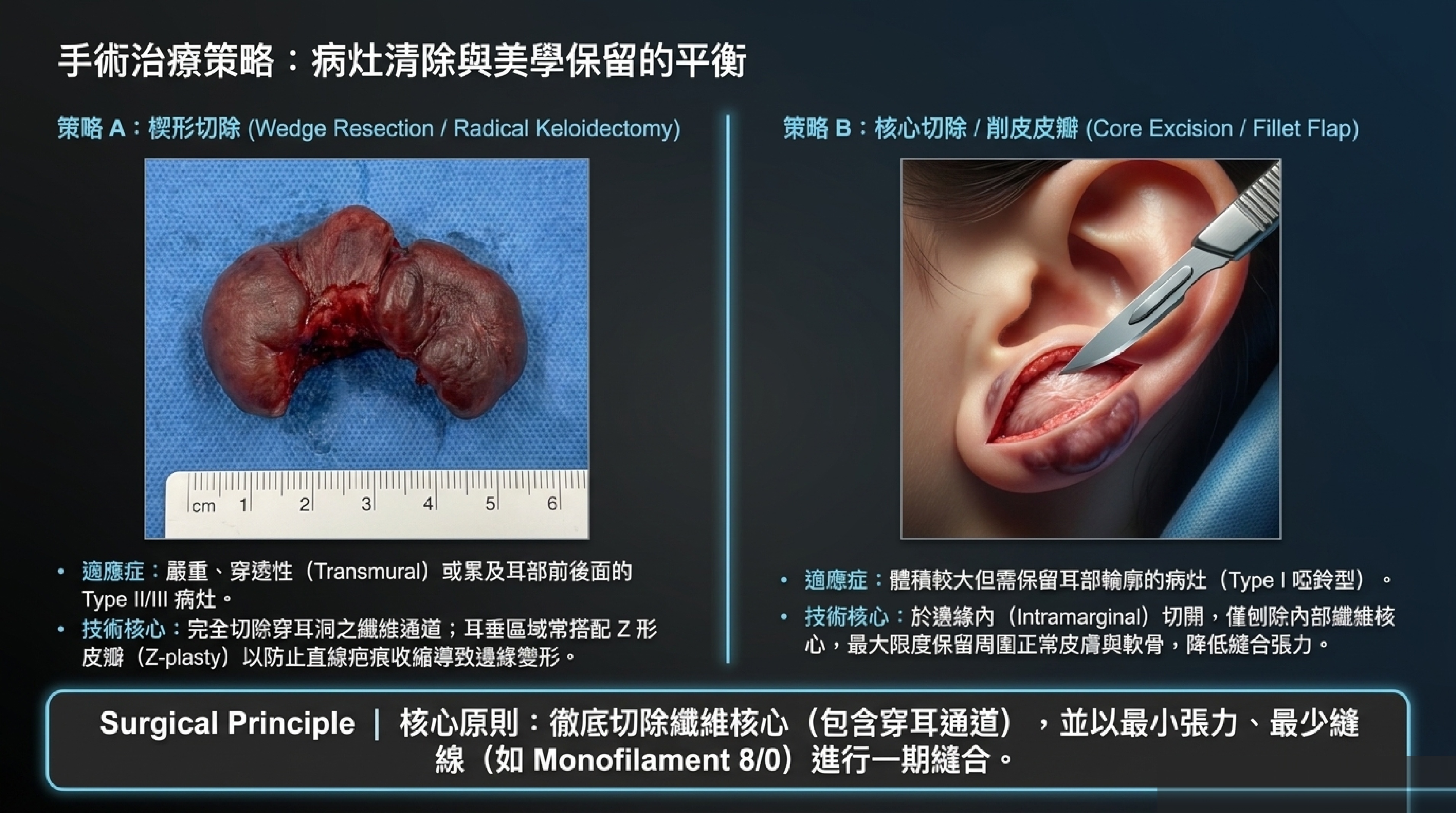 耳朵蟹足腫手術治療：楔形切除（Wedge Resection）與核心切除（Core Excision / Fillet Flap）
