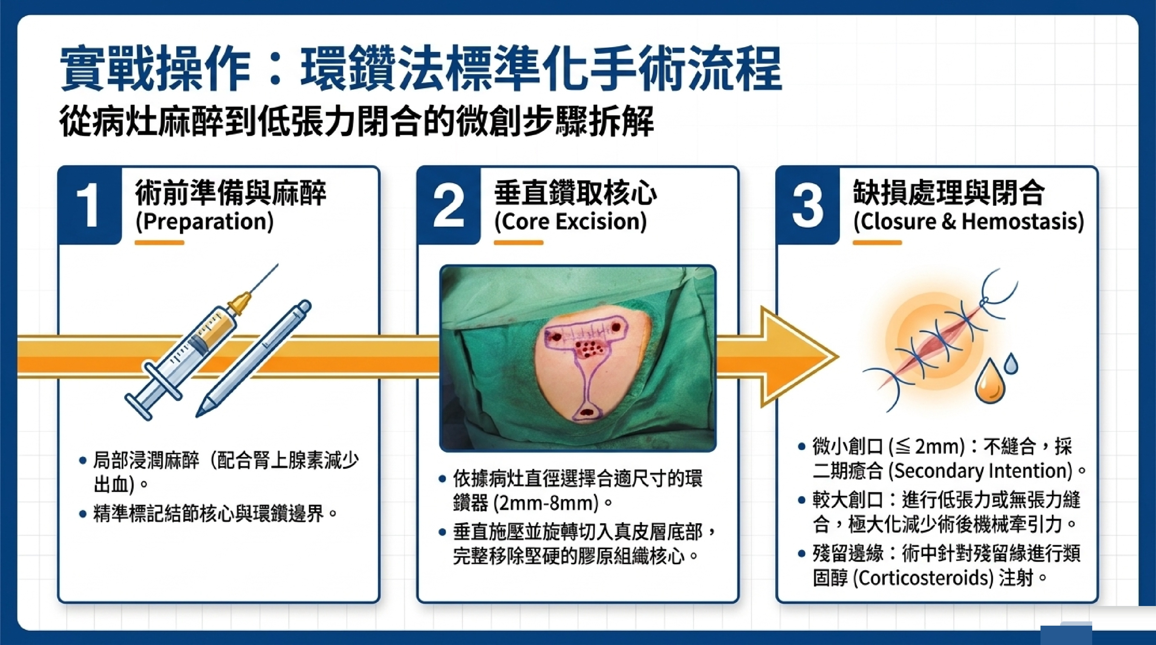 環鑽法標準化手術三步驟：術前準備與麻醉、垂直鑽取核心、缺損處理與閉合