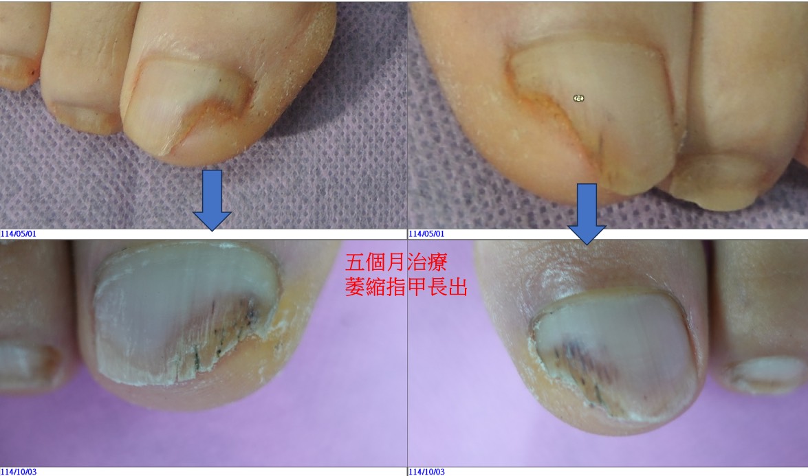 萎縮指甲治療前後對比