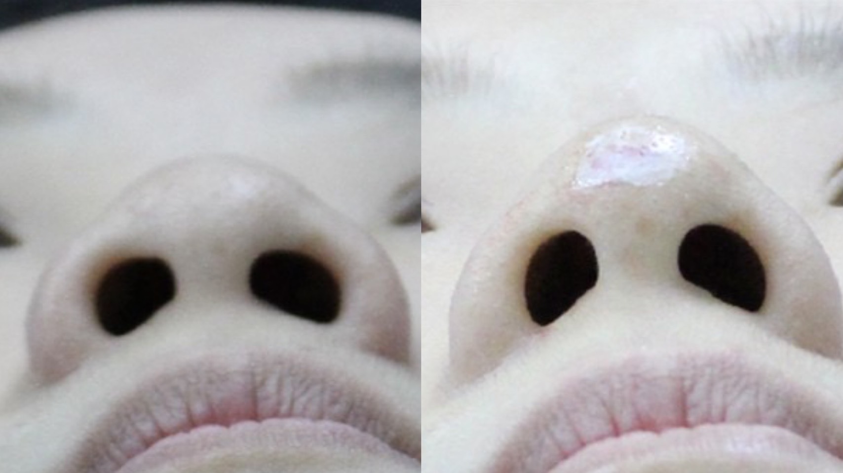 永井宏治 | 鼻中隔延长+硅胶隆鼻+埋线双眼皮 - 知乎